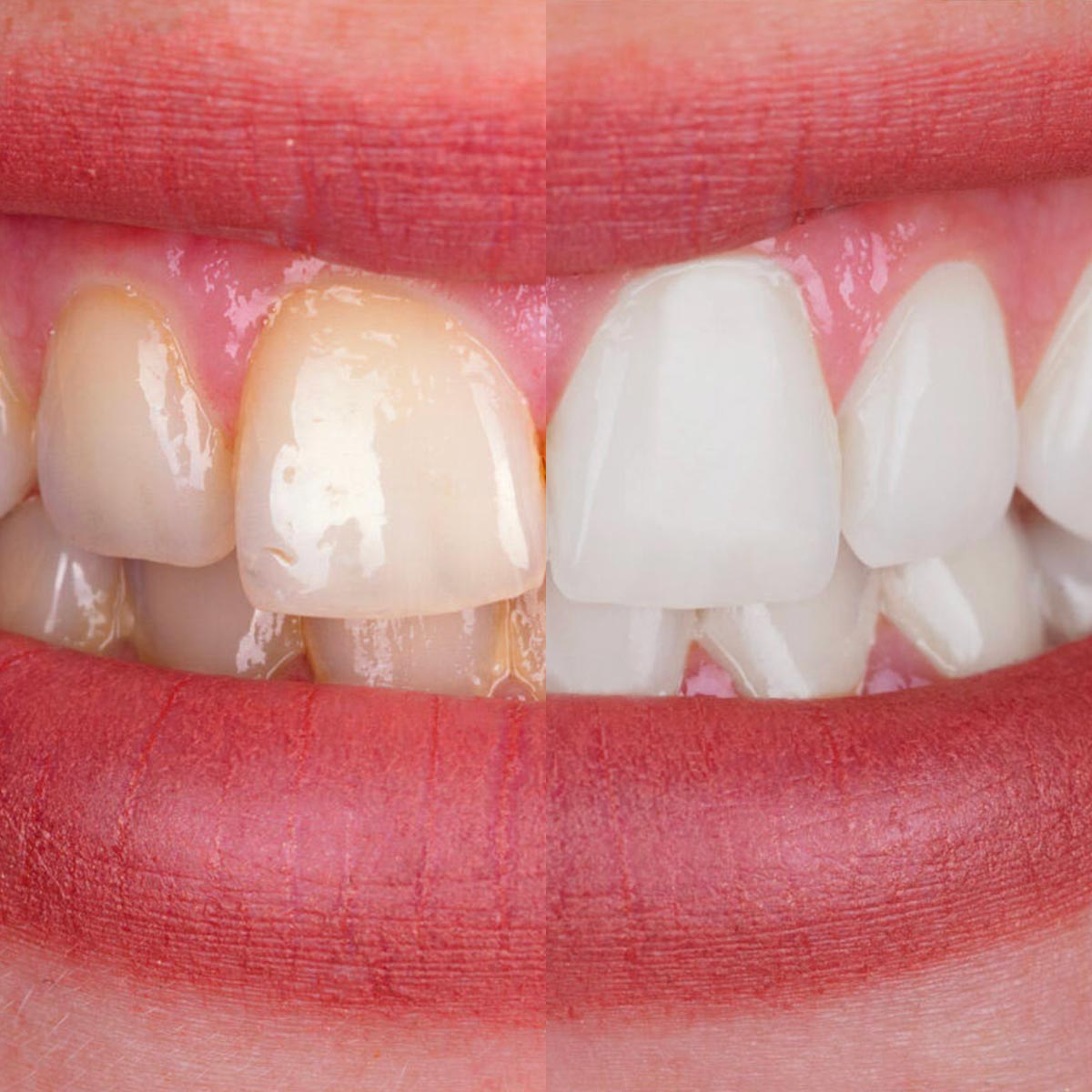 Whitening Strips